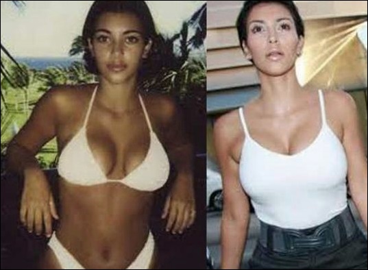 Kim Kardashian Vorwürfe der plastischen Chirurgie  