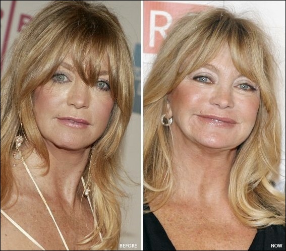 Goldie Hawn Plastische Chirurgie Facelifting zum Entfernen von Falten  