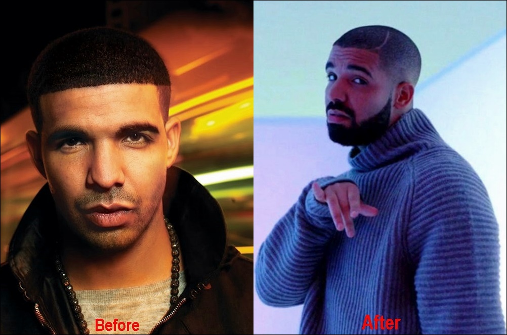 Hat Drake eine Nase Job Plastische Chirurgie vor nach Fotos  