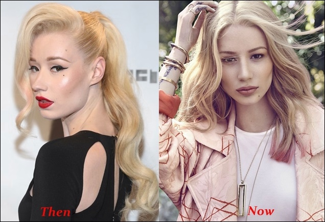 Iggy Azalea Nase Job Plastische Chirurgie vor und nach Gesicht  