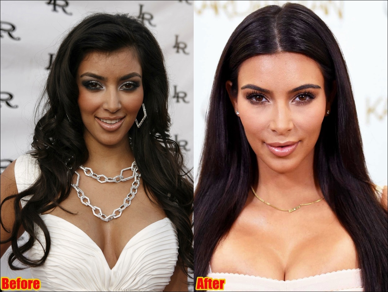 Kim Kardashian Gesichtschirurgie vor und nach Fotos  