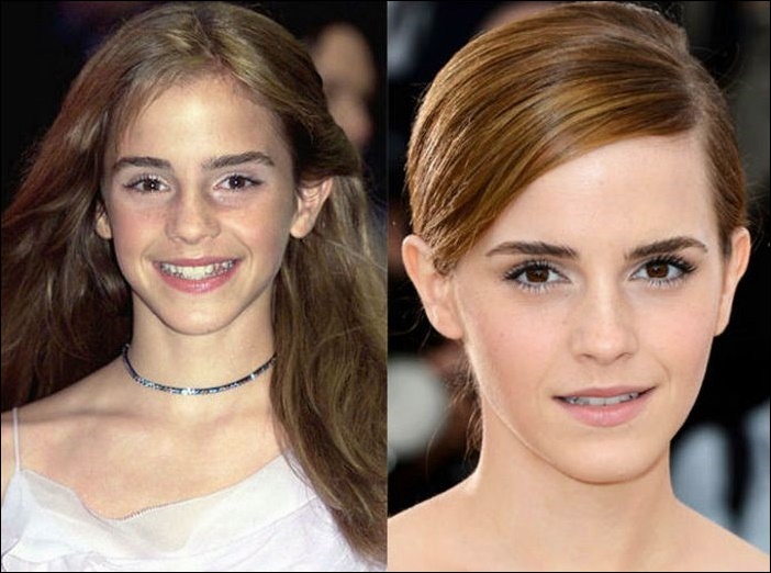Emma Watson Plastische Operationen  