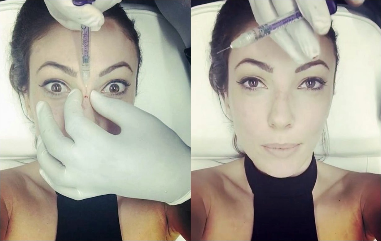Sophie Gradon Nase Job Plastische Chirurgie vor und nach Instagram  