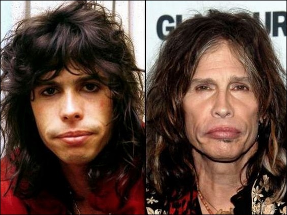 Steven Tyler plastische Chirurgie  