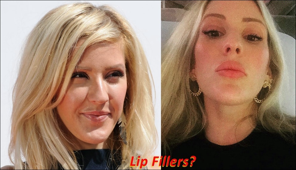 Ellie Goulding Plastische Chirurgie vor und nach Boob Job, Lip Filler, Nase Job  