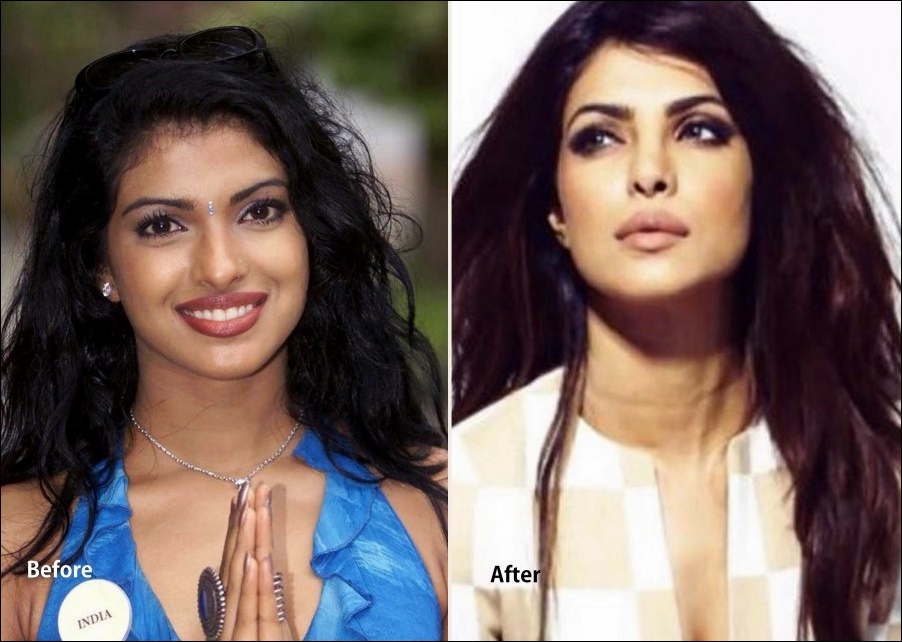 Priyanka Chopra perfekte plastische Chirurgie für Miss World!  