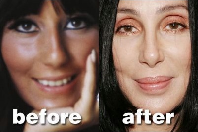 Cher Plastische Chirurgie - Facelift, Nase Job & Brustimplantate  