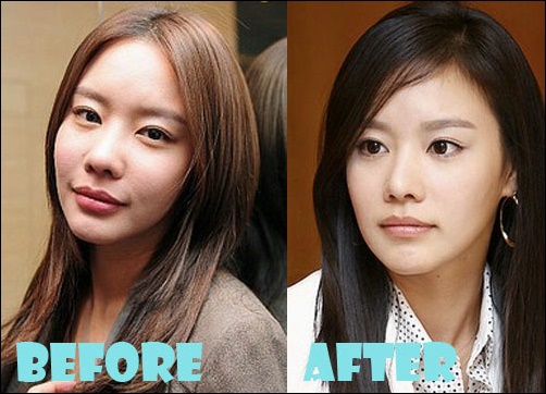 Kim Ah Joong Plastische Chirurgie Vorher-Nachher Bilder, Fotos  