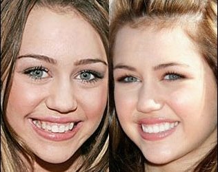 Miley Cyrus Nase Job Plastische Chirurgie vor und nach Fotos  