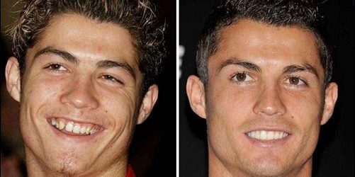 Cristiano Ronaldo Plastische Chirurgie Vorher-Nachher Bilder  
