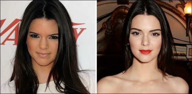 Kendall Jenner der jüngste aus dem Kardashian-Jenner-Clan nutzt Plastische Chirurgie?  