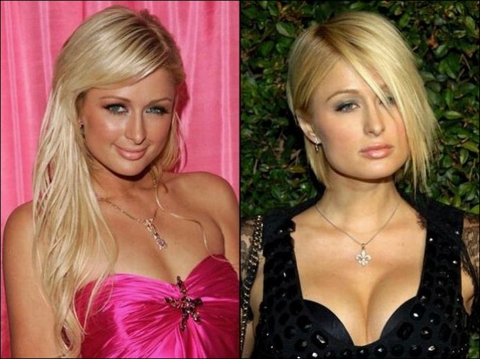 Paris Hilton bestreitet jede Art von plastischer Chirurgie  