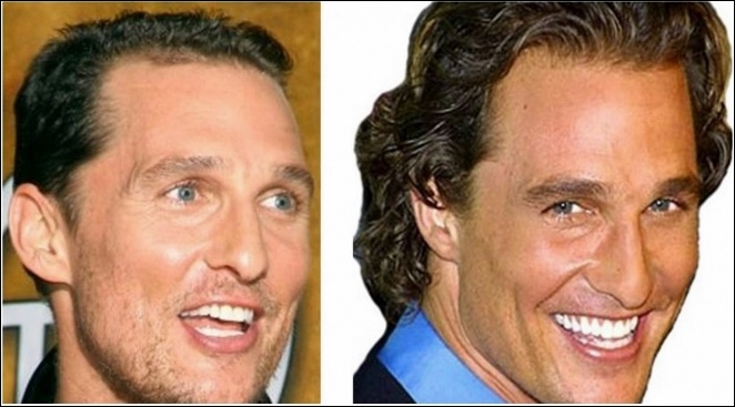 Matthew McConaughey Nase Job vor und nach  