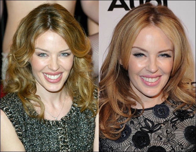 Kylie Minogue Plastische Chirurgie vor und nach Fotos  