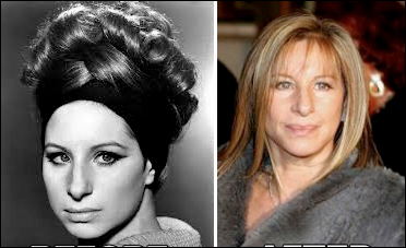 Barbra Streisand Plastische Chirurgie im Alter von 70  