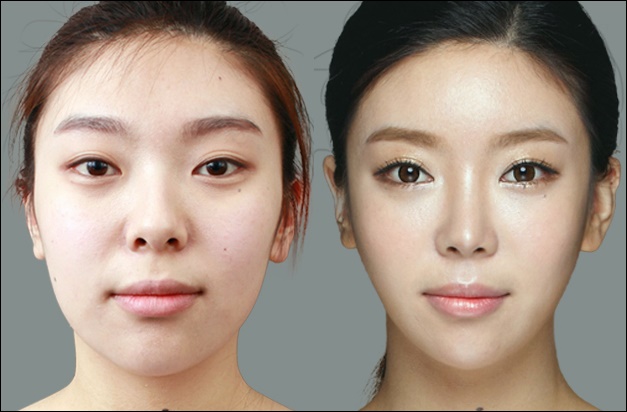 Asian Prominente Plastische Chirurgie vor und nach Bildern  
