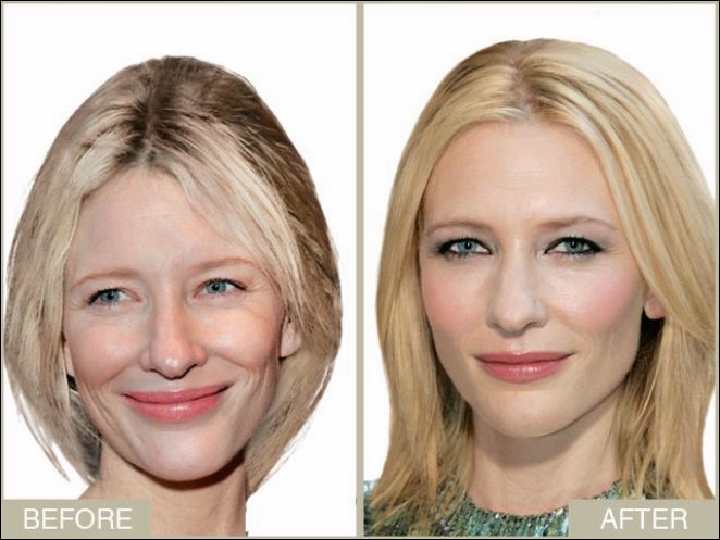 Cate Blanchett Plastische Chirurgie Vorher und Nachher  