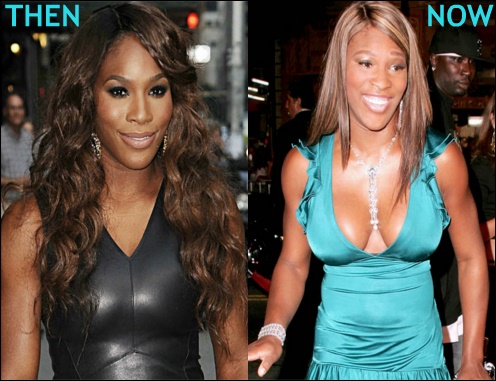 Serena Williams plastische Chirurgie vor und nach Bildern  