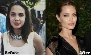 Angelina Jolie Plastische Chirurgie vor und nach Botox-Injektion Bilder  
