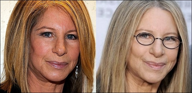 Barbra Streisand Plastische Chirurgie vor und nach Fotos  