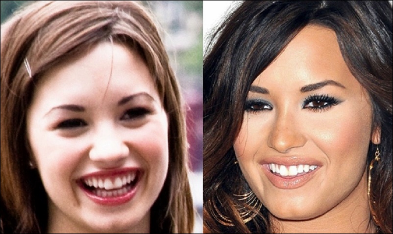 Demi Lovato Nase Job vor und nach der plastischen Chirurgie Fotos  