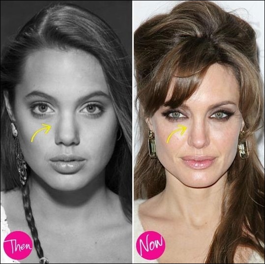 Angelina Jolie plastische Chirurgie zwickt, um ihre Schönheit zu verbessern!  