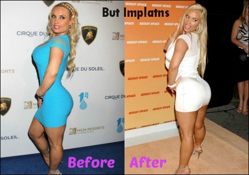 Coco Austin Butt Implantate Plastische Chirurgie vor und nach Fotos  