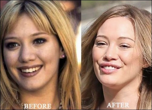 Hilary Duff Plastische Chirurgie vor und nach  
