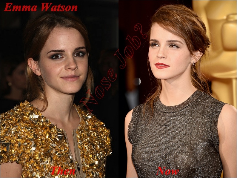 Hatte Emma Watson Nasenoperation Plastische Chirurgie oder nicht  