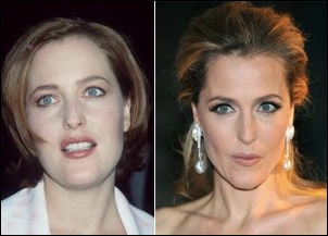 Gillian Anderson Plastische Chirurgie vor und nach Botox  