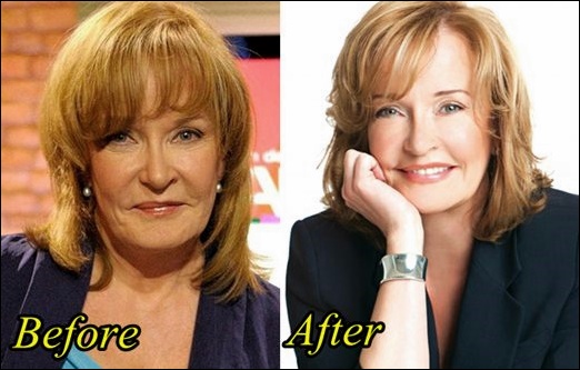 Marilyn Denis Plastische Chirurgie vor und nach Botox, Facelift Fotos  