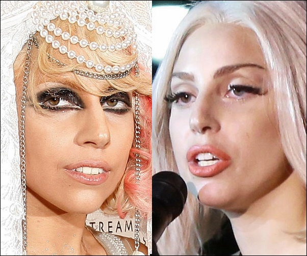 Lady Gaga Nasenoperation vor und nach Fotos  