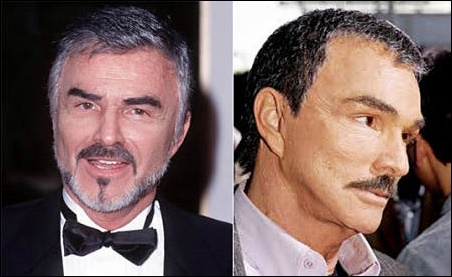 Burt Reynolds Plastische Chirurgie und kosmetische Veränderungen  