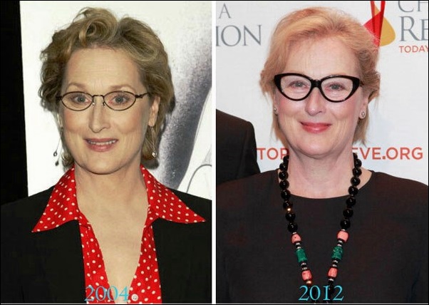 Meryl Streep Plastische Chirurgie Vorher-Nachher Bilder  