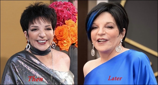 Liza Minnelli Plastische Chirurgie Vorher-Nachher Fotos  