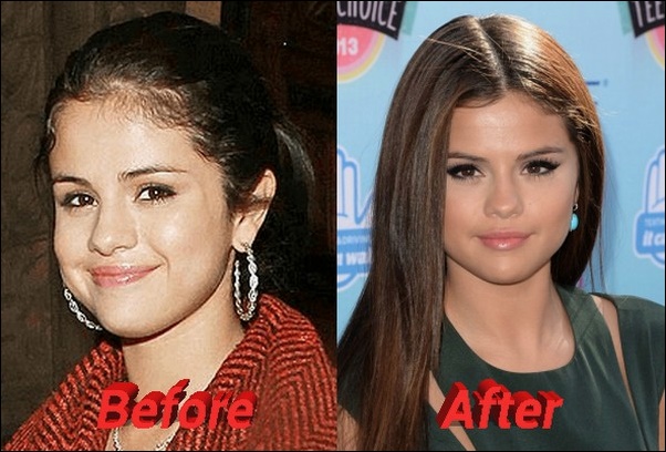 Selena Gomez Nase Job vor und nach Nasenkorrektur Fotos  