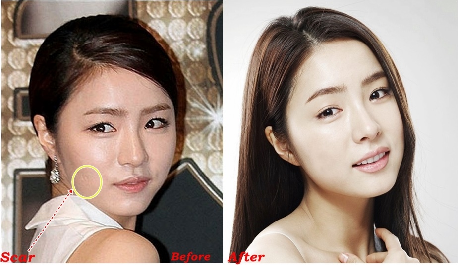 Shin Se Kyung Plastische Chirurgie Vorher und Nachher Gerücht Bilder  