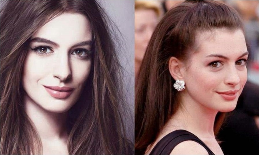 Anne Hathaway - Vor und nach der plastischen Chirurgie  