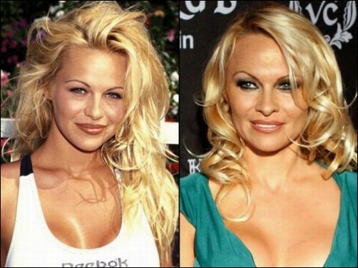 Pamela Anderson Plastische Chirurgie schlecht gegangen  