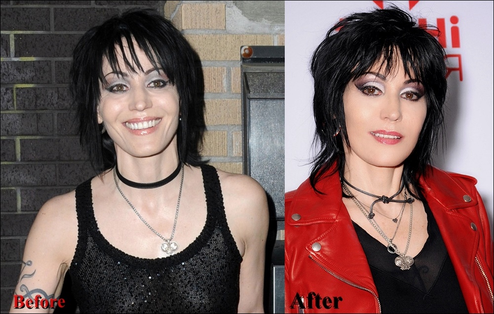 Joan Jett Plastische Chirurgie vor und nach Fotos Gesicht Bilder  